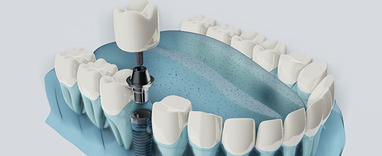 3d rendering of lower teeth with a guided implant being placed
