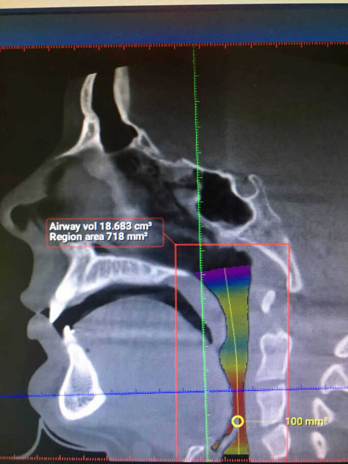 Sleep Apnea Example