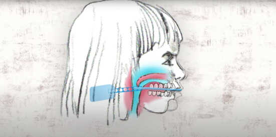 Myofunctional Therapy Example