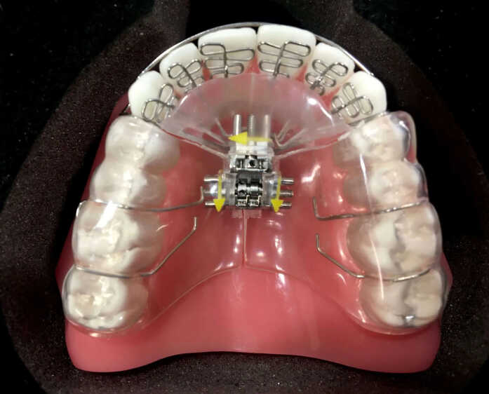 Oral Appliances Example